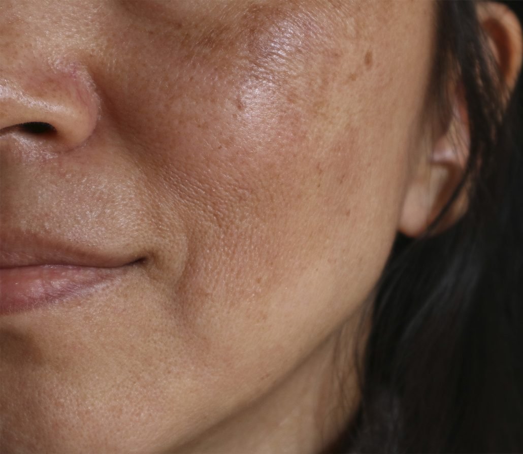 Microdermabrasion-before Microdermabrasion-before