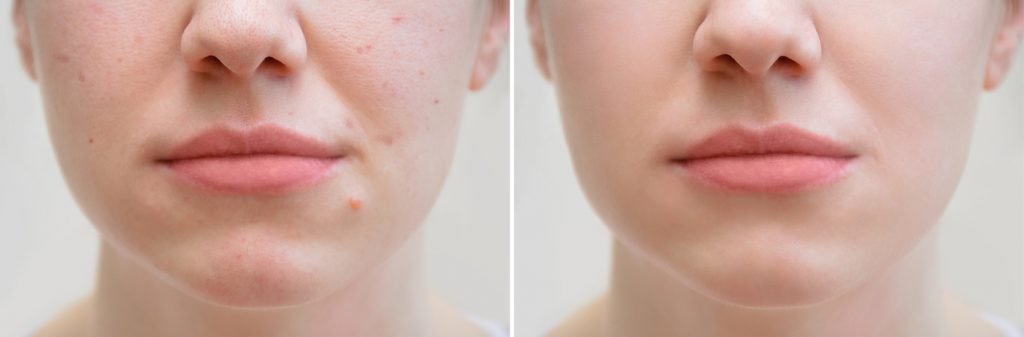 skin treatment